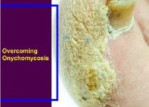 Overcoming Onychomycosis book cover