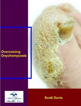 Overcoming Onychomycosis book cover